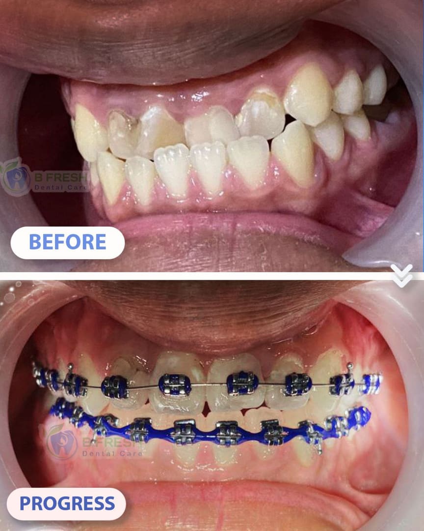 Behel Gigi #10 — hasil perawatan kasus 3 di B Fresh Dental Care