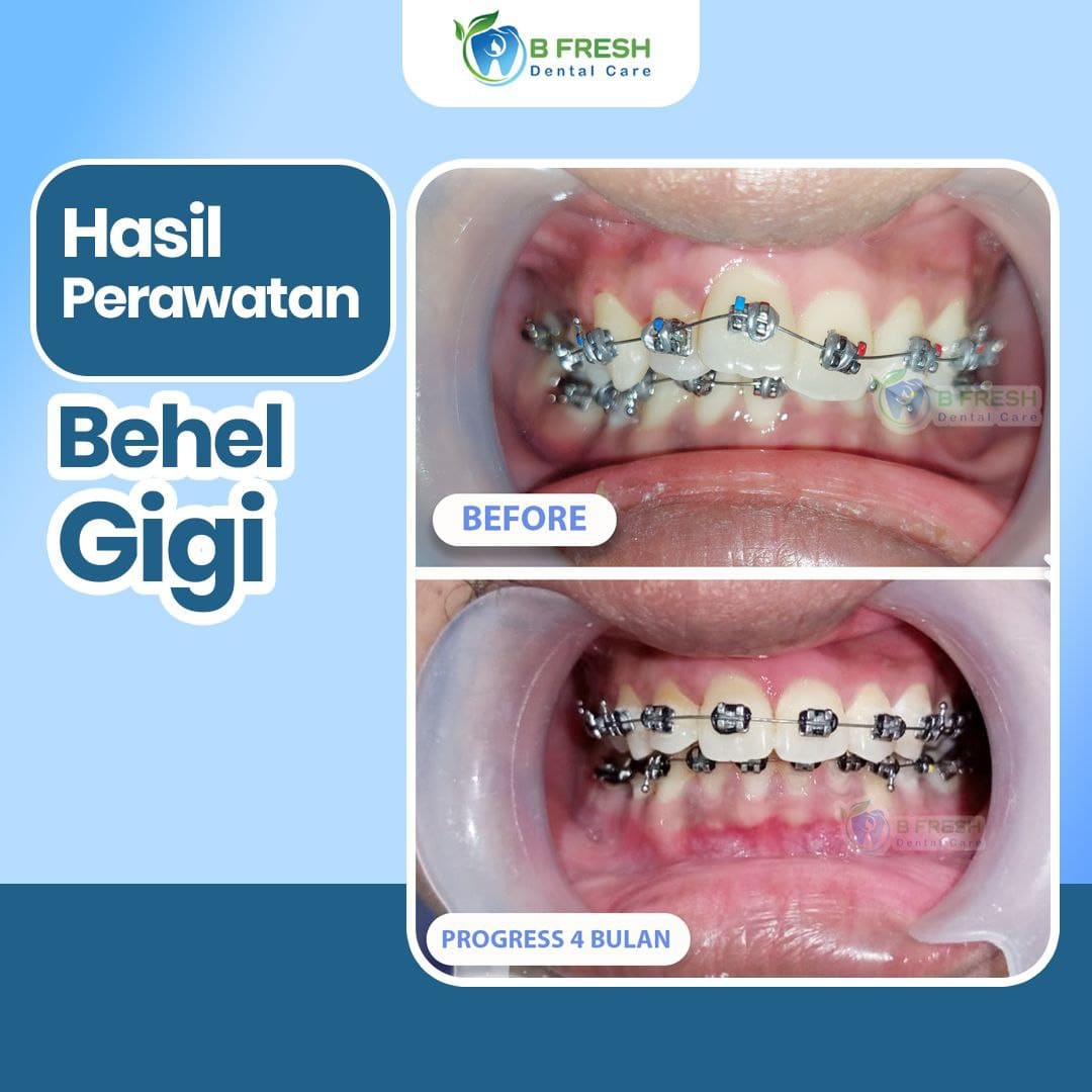 Behel Gigi #12 — hasil perawatan kasus 3 di B Fresh Dental Care