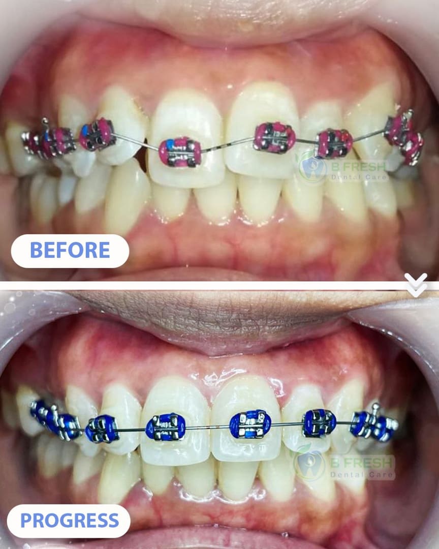 Behel Gigi #13 — hasil perawatan B Fresh Dental Care