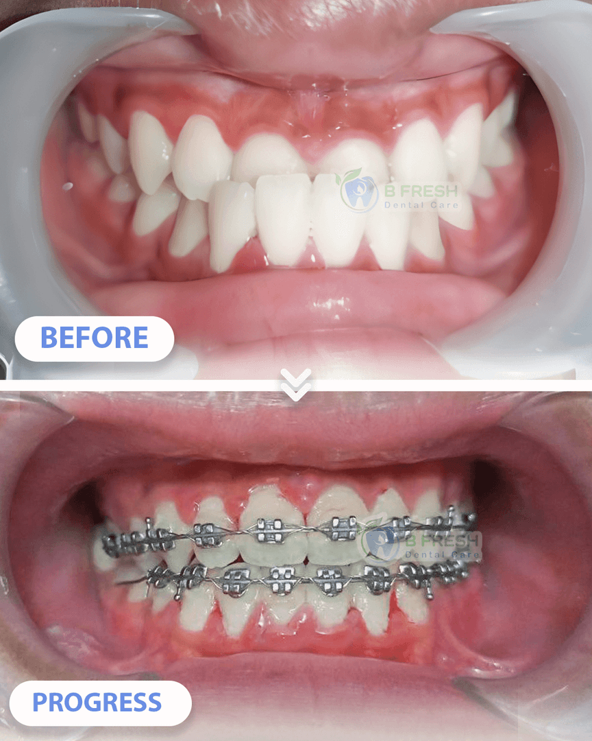 Behel Gigi #13 — hasil perawatan kasus 3 di B Fresh Dental Care