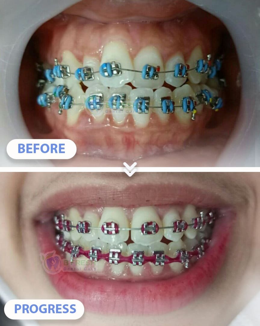 Behel Gigi #14 — hasil perawatan kasus 3 di B Fresh Dental Care