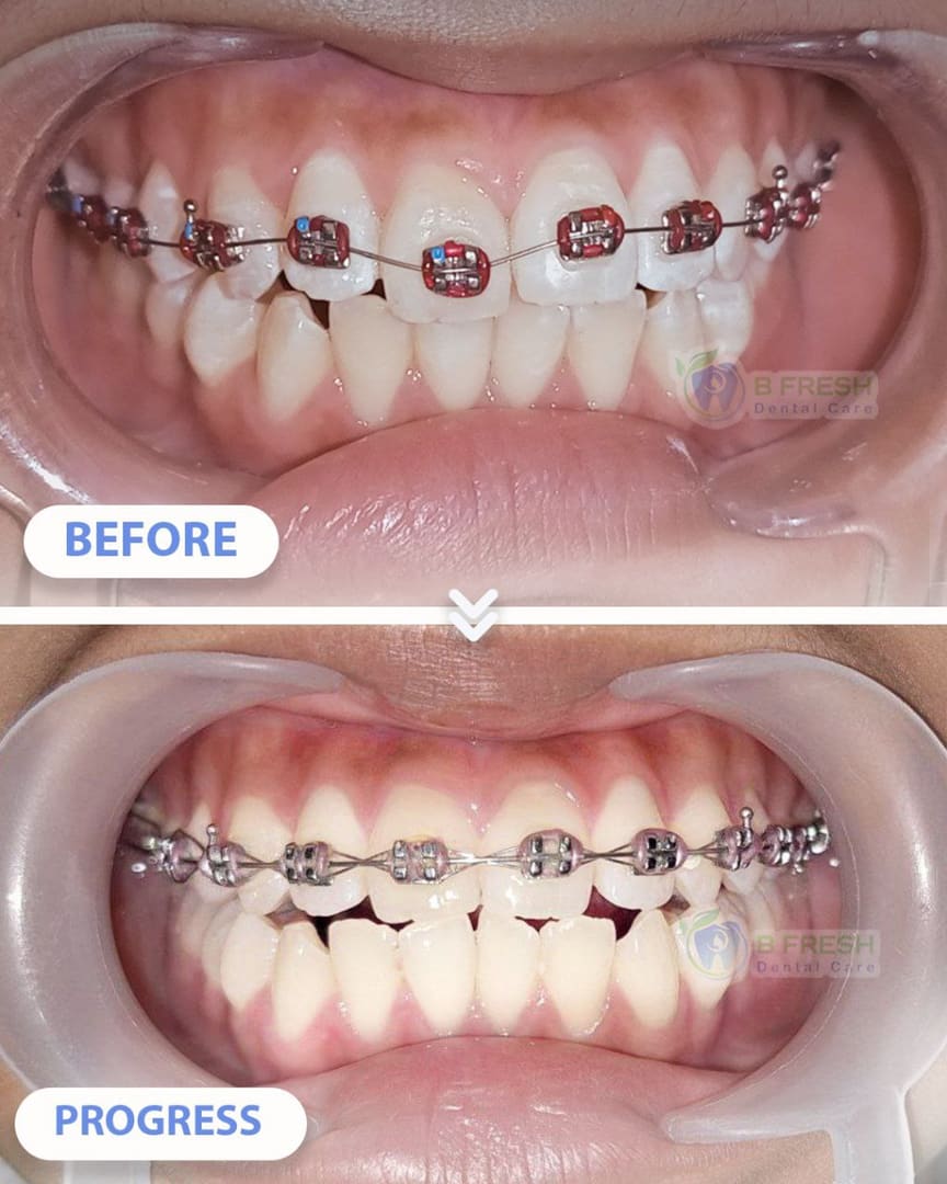 Behel Gigi #3 — hasil perawatan kasus 1 di B Fresh Dental Care