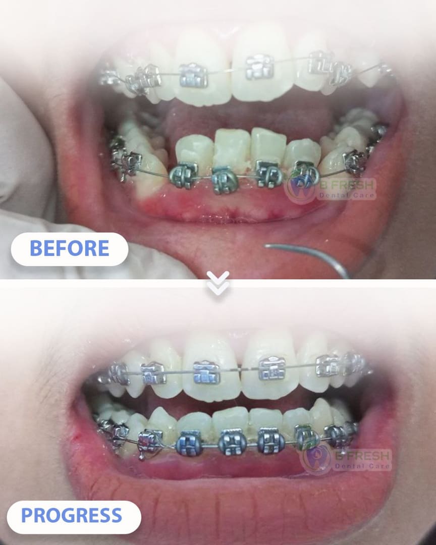 Behel Gigi #4 — hasil perawatan B Fresh Dental Care