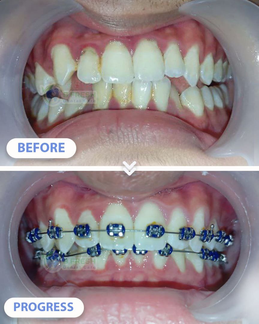 Behel Gigi #3 — hasil perawatan kasus 3 di B Fresh Dental Care