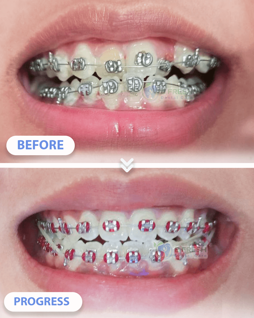 Behel Gigi #6 — hasil perawatan kasus 2 di B Fresh Dental Care