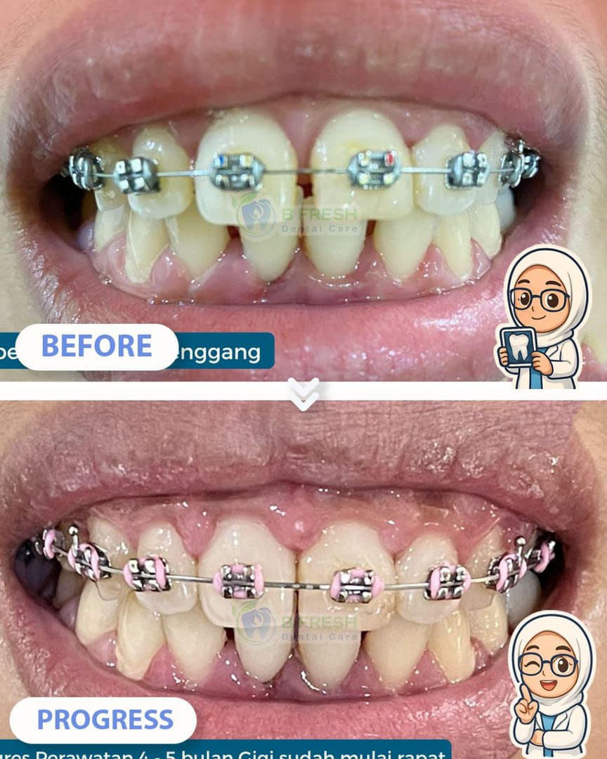 Behel Gigi #8 — hasil perawatan kasus 1 di B Fresh Dental Care