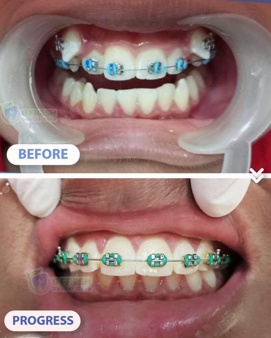 Behel Gigi #8 — hasil perawatan kasus 3 di B Fresh Dental Care