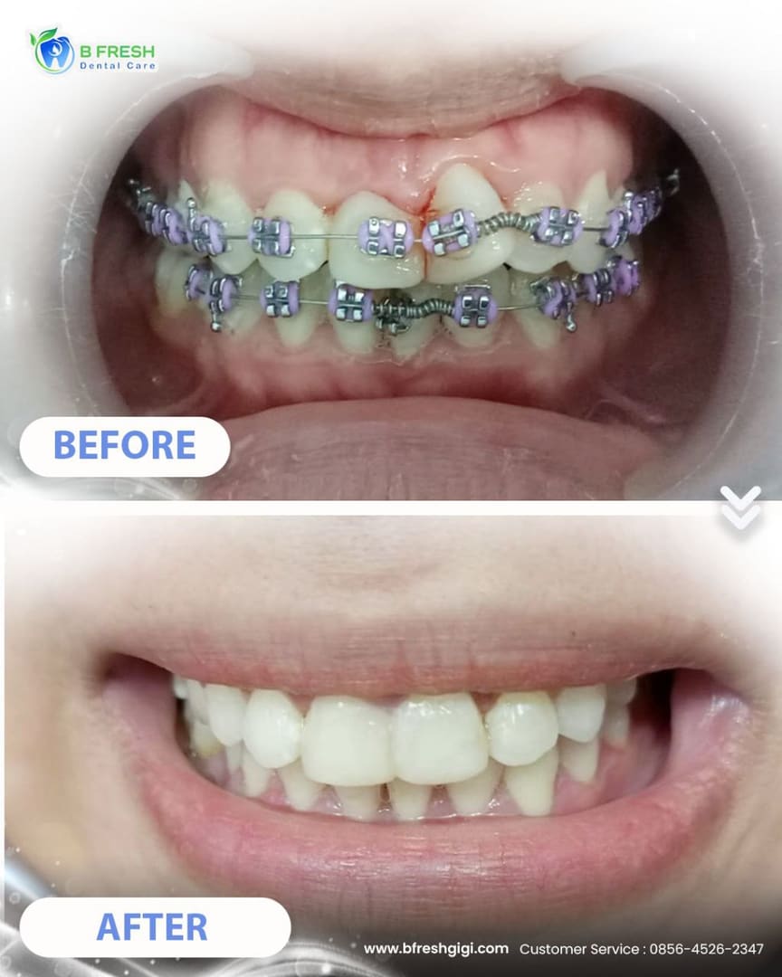 Behel Gigi #9 — hasil perawatan kasus 1 di B Fresh Dental Care