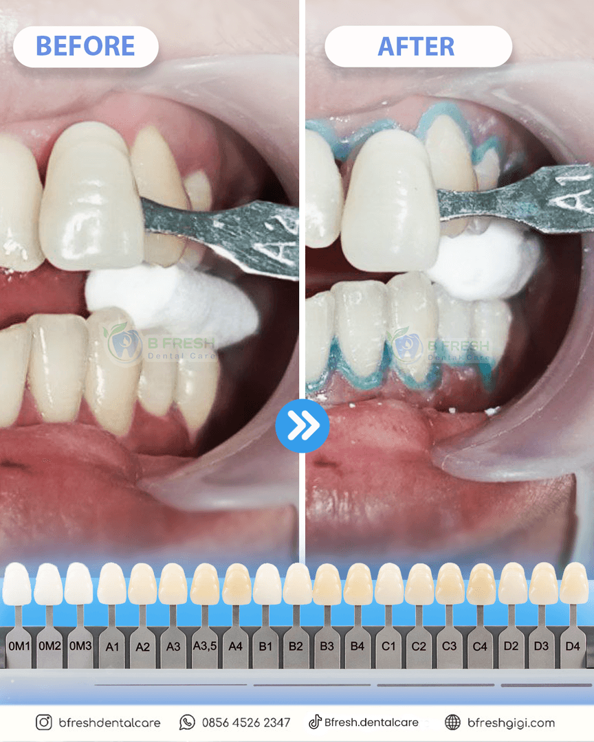 Bleaching #2 — hasil perawatan B Fresh Dental Care