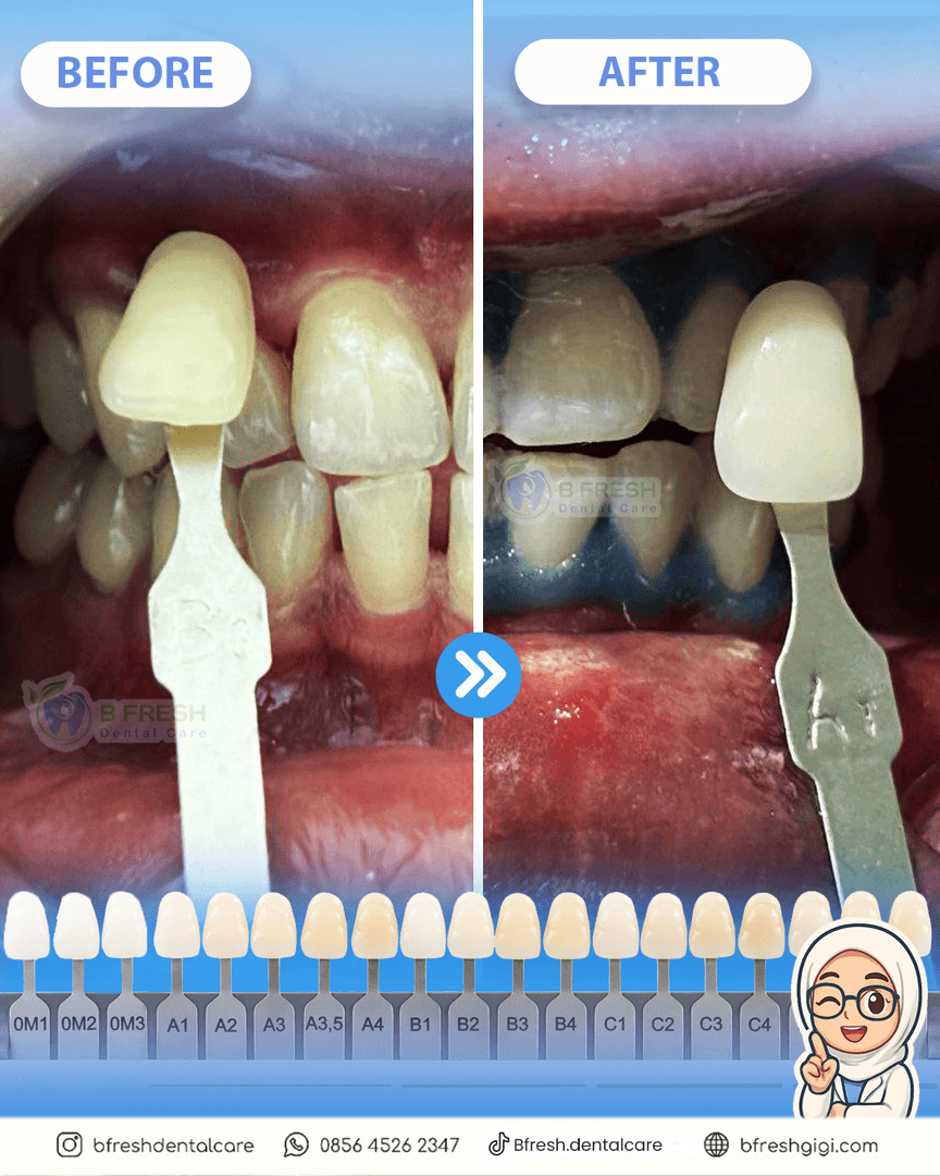 Bleaching #2 — hasil perawatan kasus 2 di B Fresh Dental Care