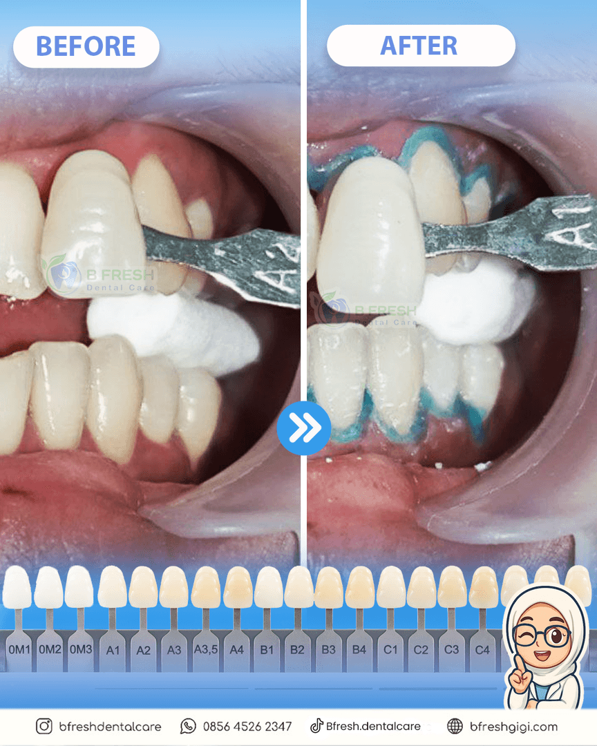 Bleaching #2 — hasil perawatan kasus 3 di B Fresh Dental Care