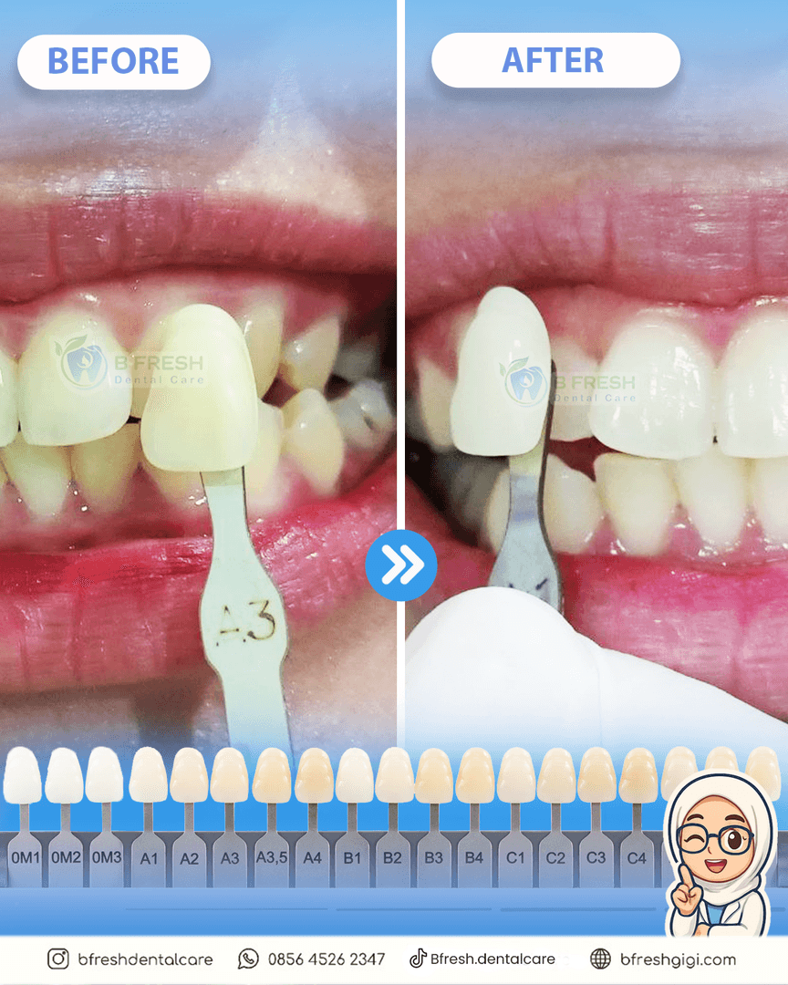 Bleaching #4 — hasil perawatan B Fresh Dental Care
