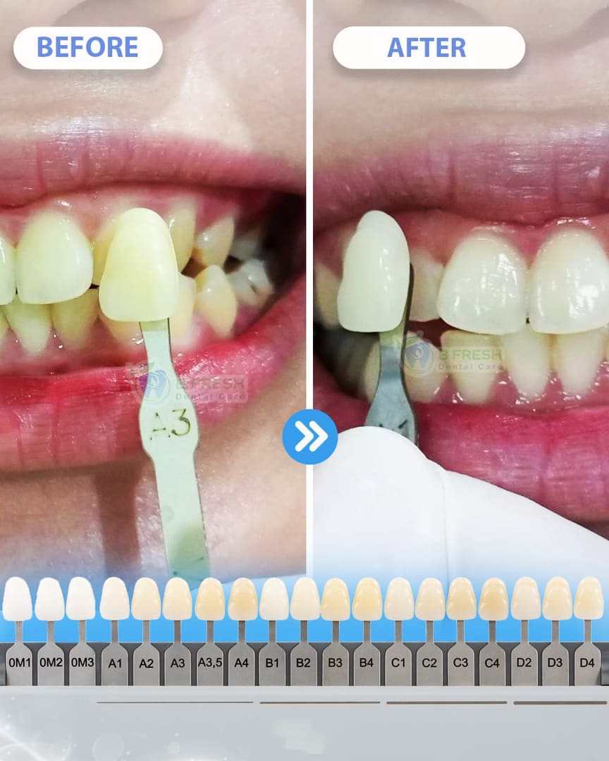 Bleaching #4 — hasil perawatan kasus 3 di B Fresh Dental Care
