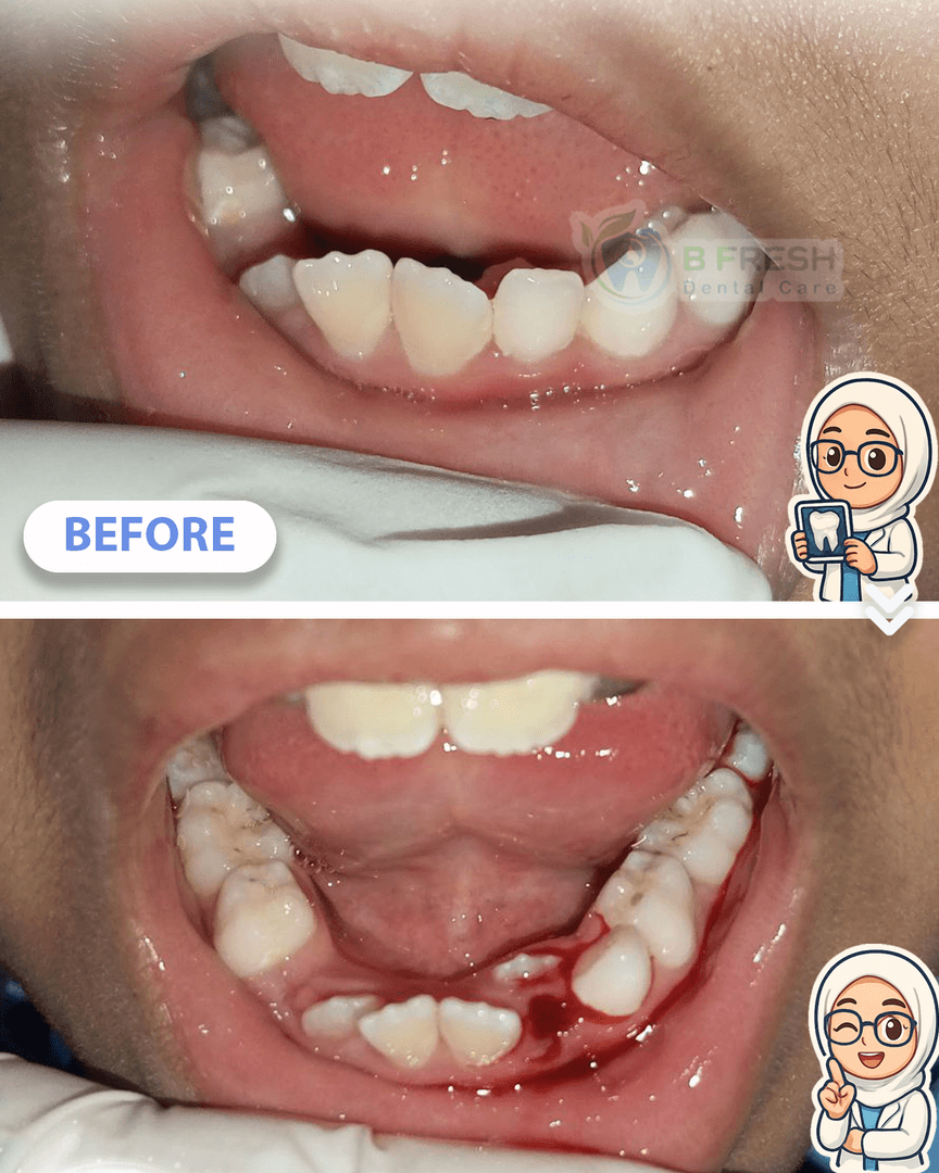 Cabut Gigi Anak #3 — hasil perawatan B Fresh Dental Care