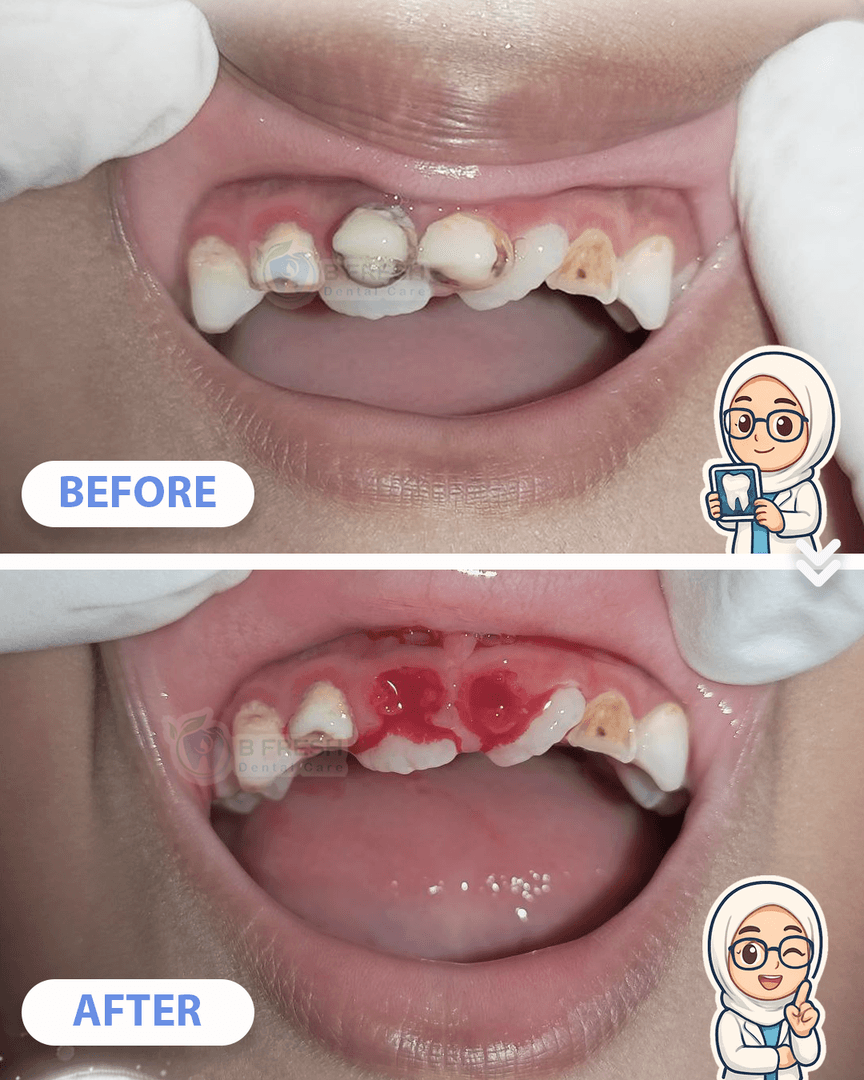 Cabut Gigi Anak #3 — hasil perawatan kasus 2 di B Fresh Dental Care