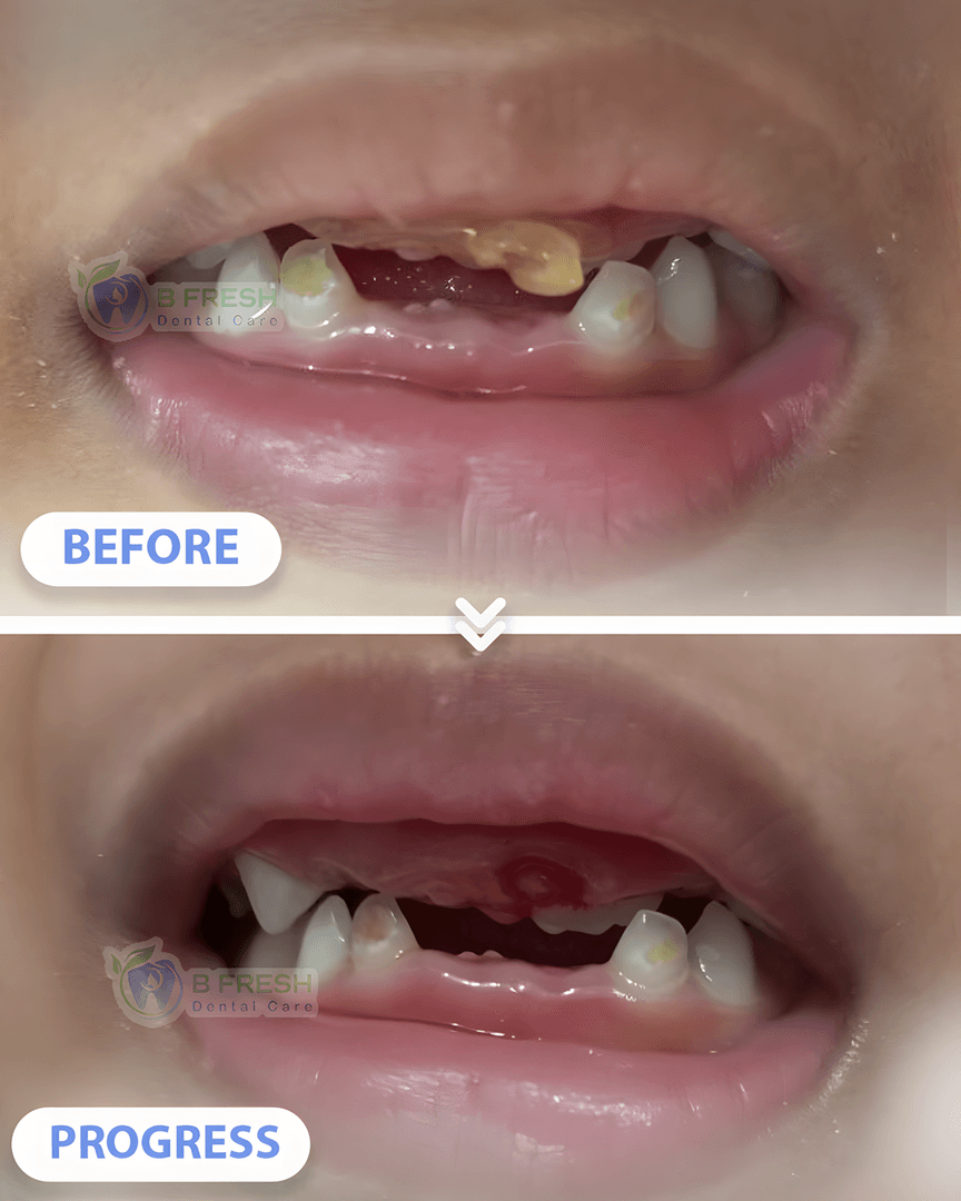Cabut Gigi Anak #3 — hasil perawatan kasus 3 di B Fresh Dental Care
