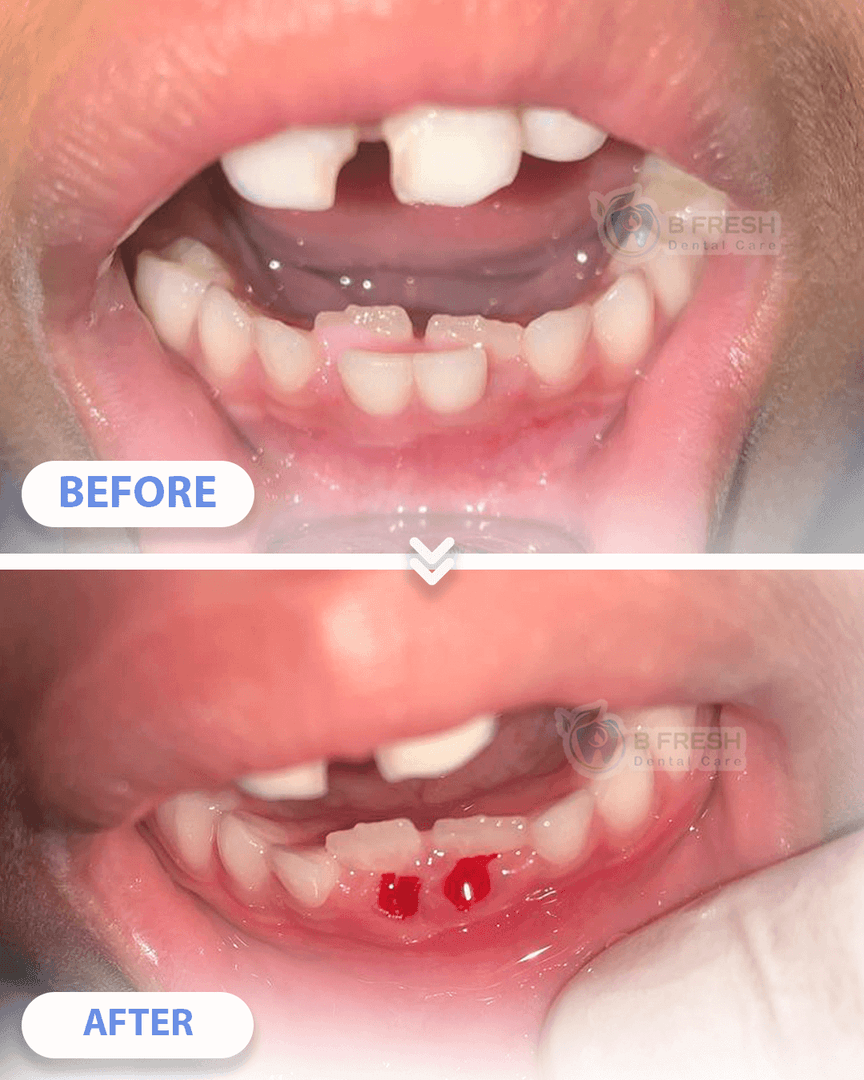 Cabut Gigi Susu #1 — hasil perawatan B Fresh Dental Care