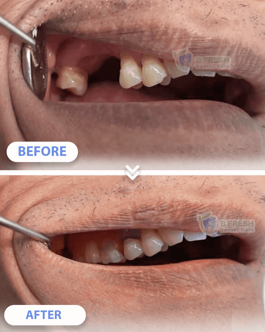 Gigi Palsu #1 — hasil perawatan B Fresh Dental Care