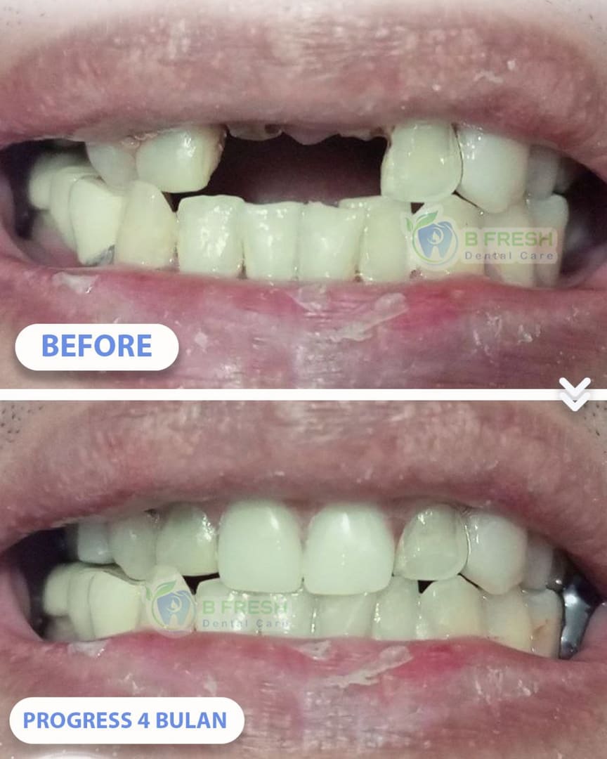 Gigi Palsu #1 — hasil perawatan kasus 2 di B Fresh Dental Care