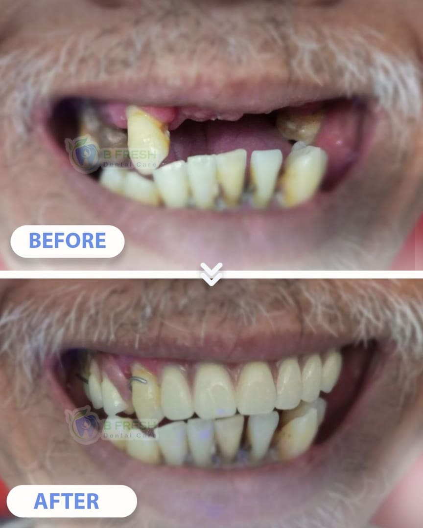 Gigi Palsu #Akrilik — hasil perawatan B Fresh Dental Care