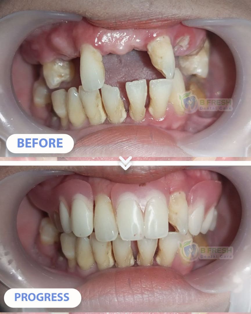 Gigi Palsu #Lucitone — hasil perawatan B Fresh Dental Care