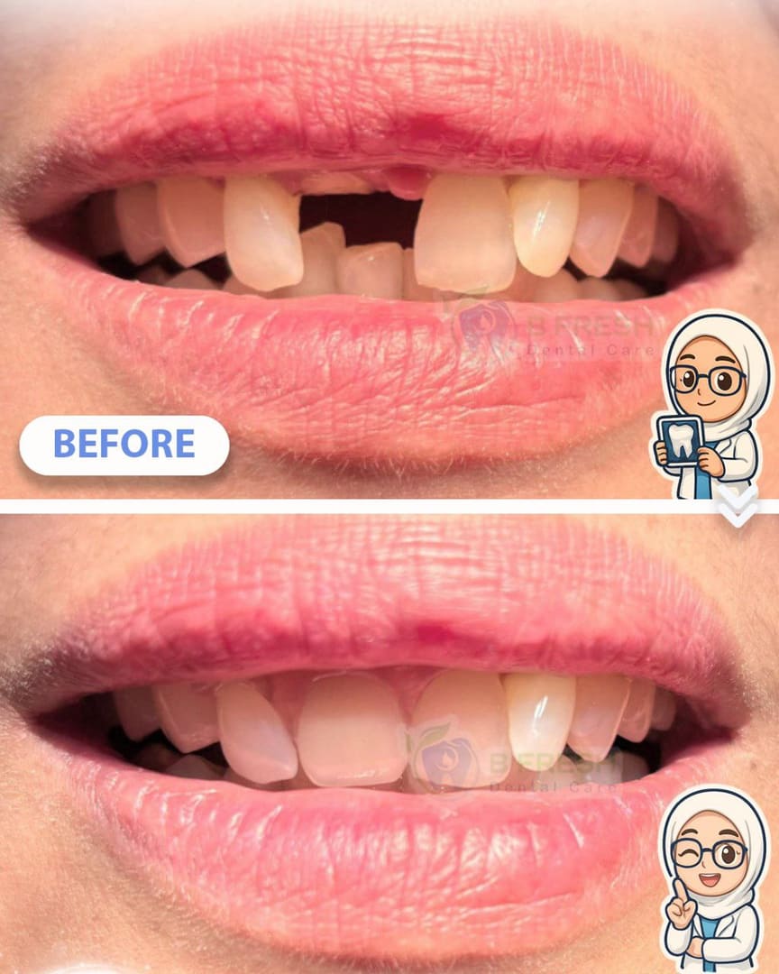 Gigi Palsu #Valplast — hasil perawatan B Fresh Dental Care