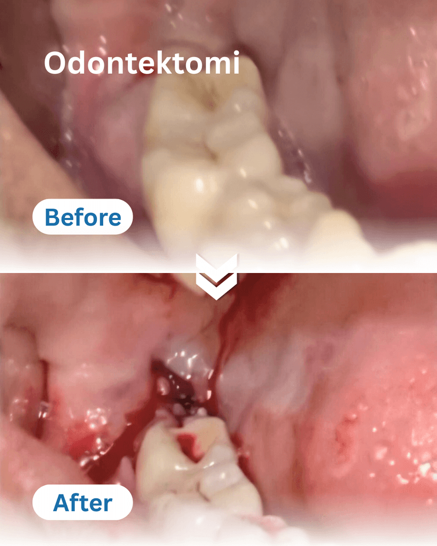 Odontektomi #1 — hasil perawatan kasus 2 di B Fresh Dental Care