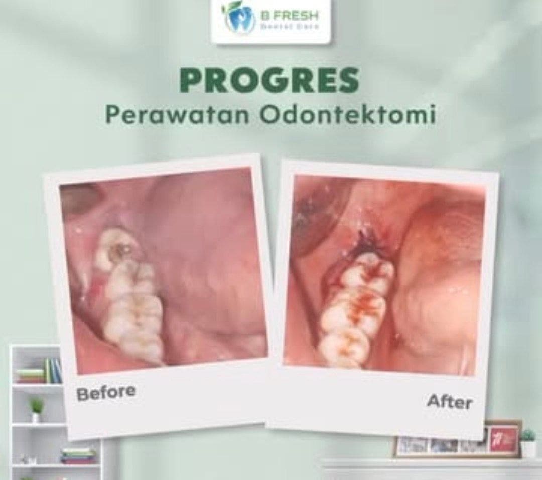 Odontektomi #2 — hasil perawatan kasus 2 di B Fresh Dental Care