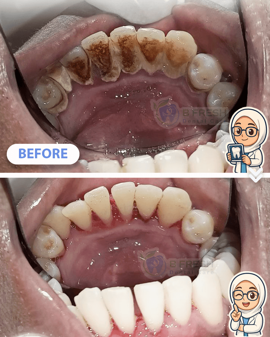 Scalling #2 — hasil perawatan B Fresh Dental Care