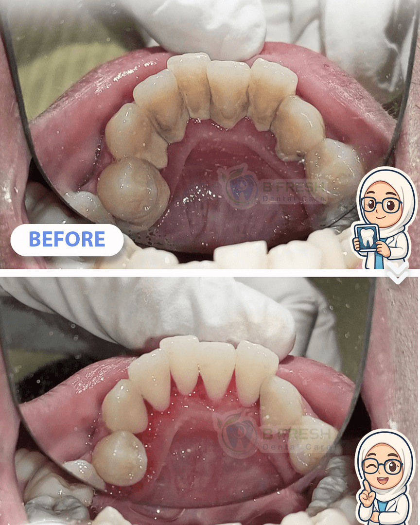 Scalling #3 — hasil perawatan B Fresh Dental Care