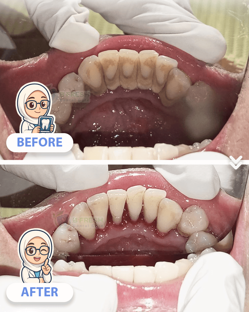 Scalling #4 — hasil perawatan B Fresh Dental Care