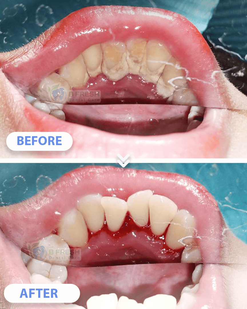 Scalling #5 — hasil perawatan B Fresh Dental Care