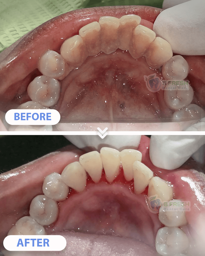Scalling #6 — hasil perawatan B Fresh Dental Care