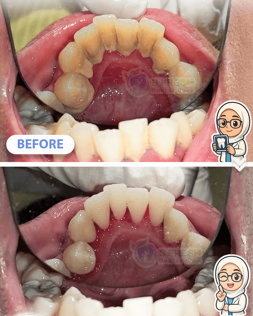 Scalling #7 — hasil perawatan B Fresh Dental Care