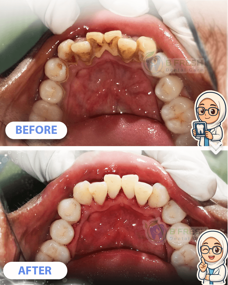 Scalling #8 — hasil perawatan B Fresh Dental Care