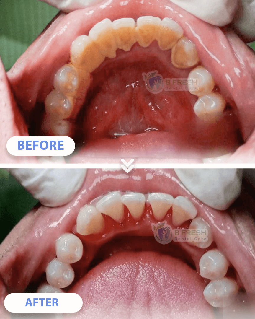 Scalling #8 — hasil perawatan kasus 2 di B Fresh Dental Care