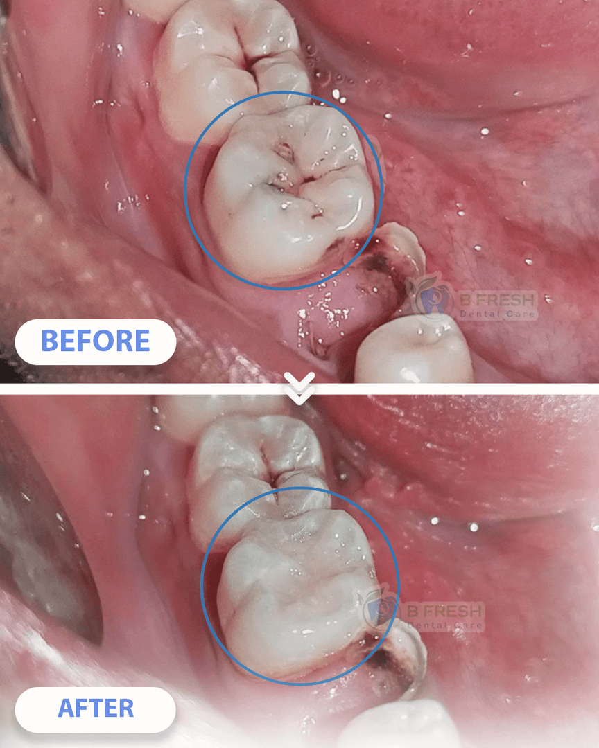 Tambal Gigi Belakang #2 — hasil perawatan B Fresh Dental Care