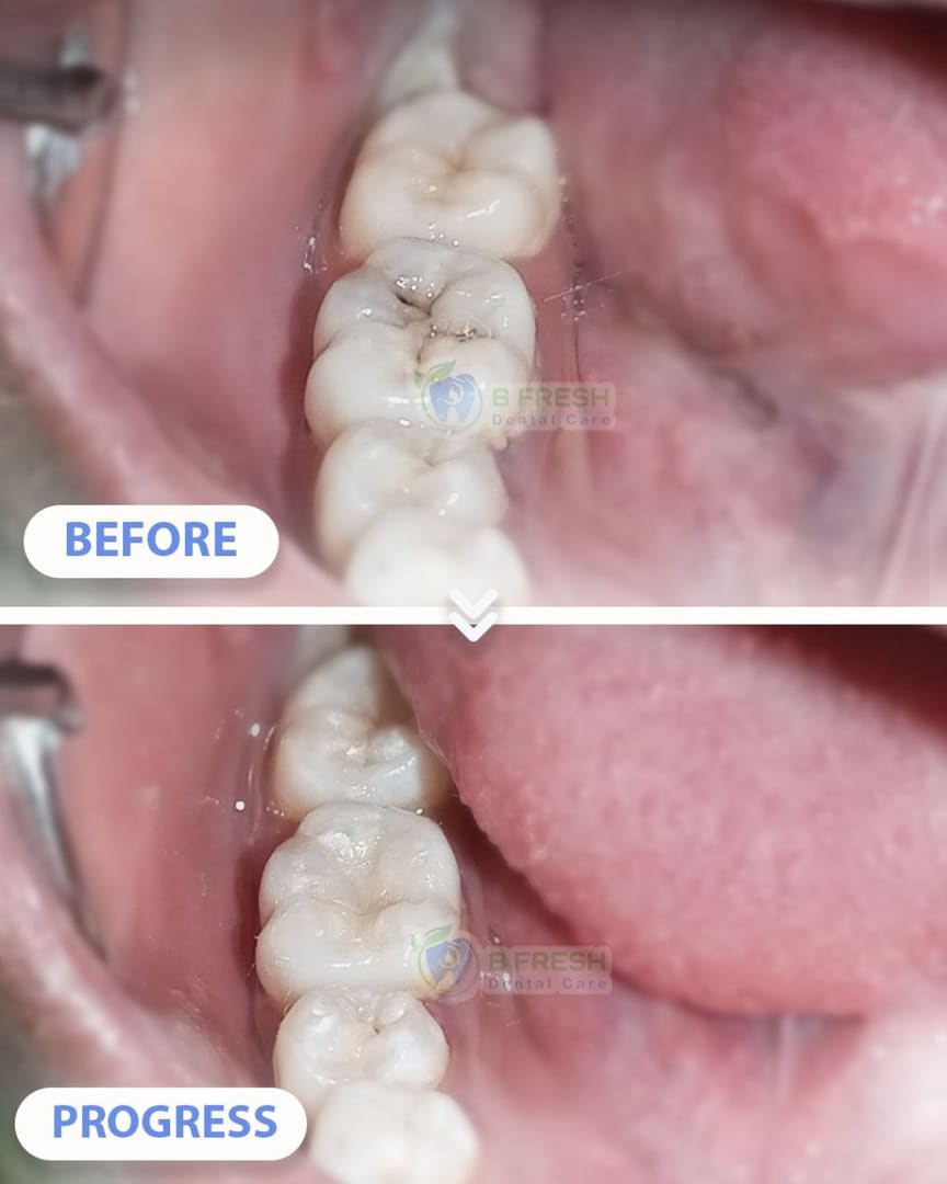 Tambal Gigi Belakang #10 — hasil perawatan B Fresh Dental Care