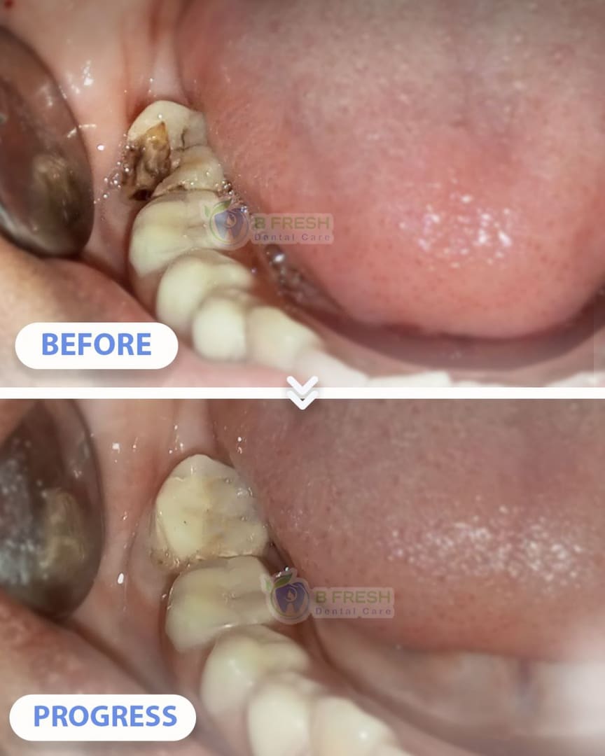 Tambal Gigi Belakang #11 — hasil perawatan B Fresh Dental Care