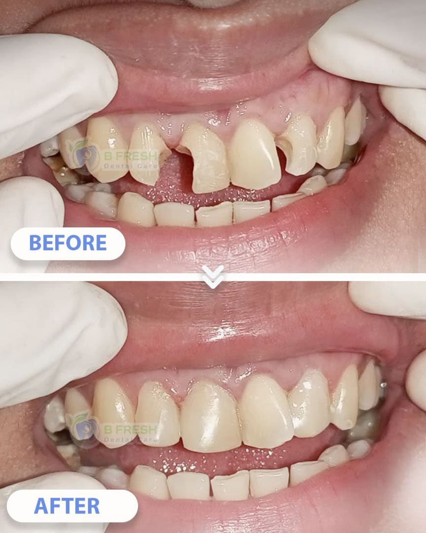 Tambal Gigi Depan #12 — hasil perawatan B Fresh Dental Care