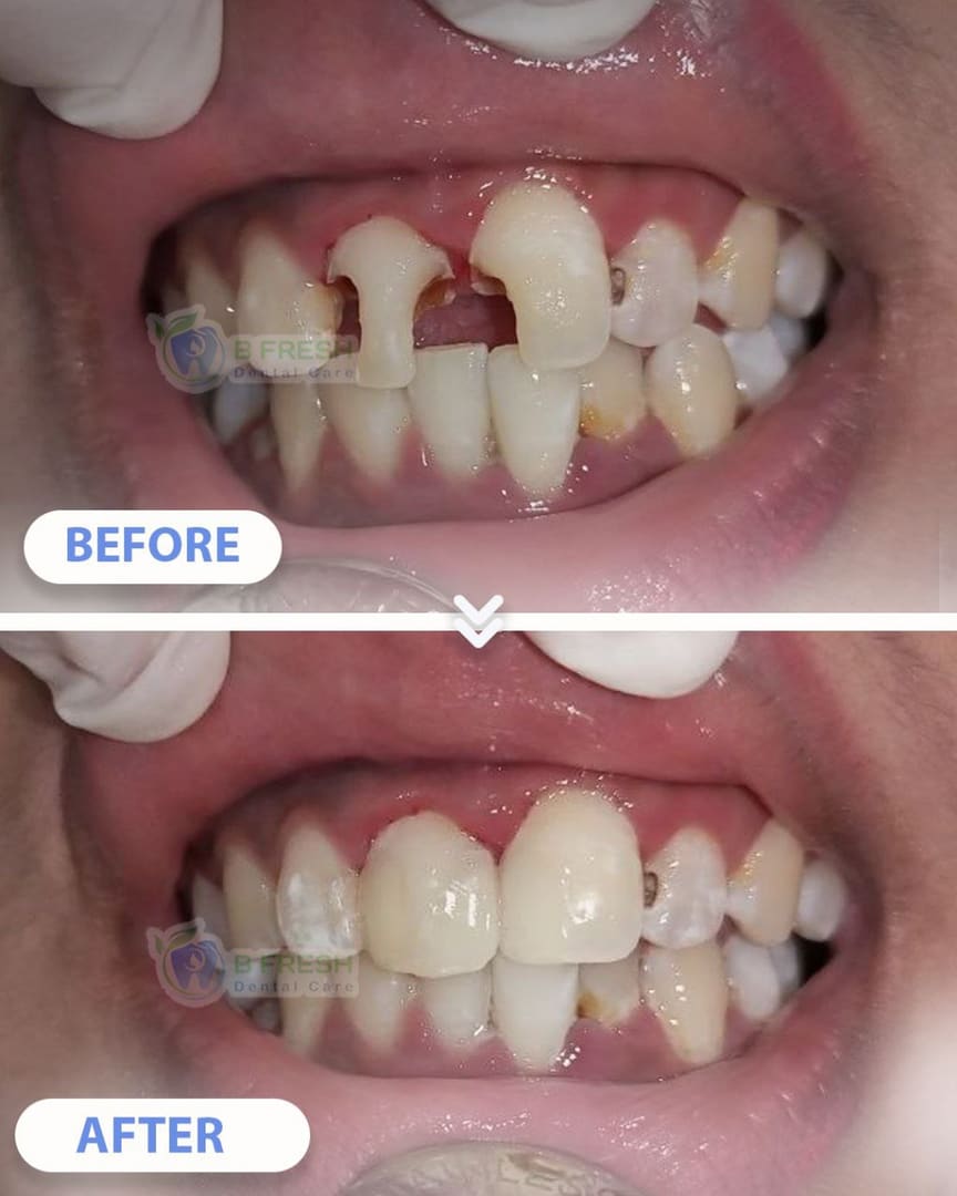 Tambal Gigi Depan #13 — hasil perawatan B Fresh Dental Care