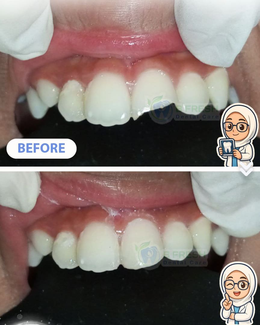 Tambal Gigi Depan #13 — hasil perawatan kasus 3 di B Fresh Dental Care