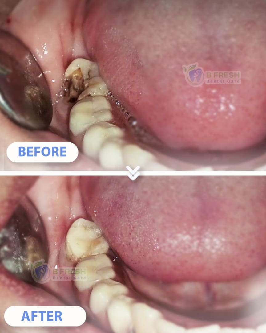 Tambal Gigi Belakang #14 — hasil perawatan B Fresh Dental Care