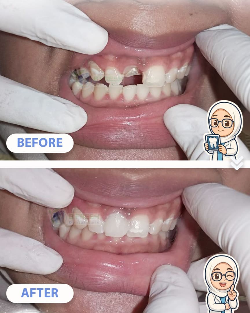 Tambal Gigi Depan #15 — hasil perawatan B Fresh Dental Care