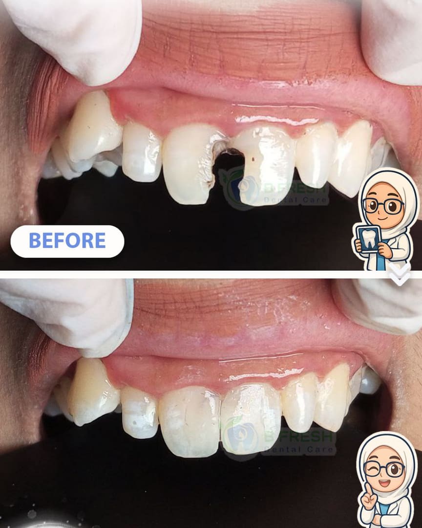 Tambal Gigi Depan #18 — hasil perawatan kasus 1 di B Fresh Dental Care