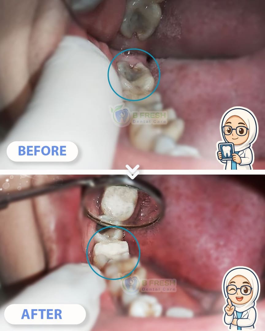 Tambal Gigi Belakang #19 — hasil perawatan kasus 1 di B Fresh Dental Care