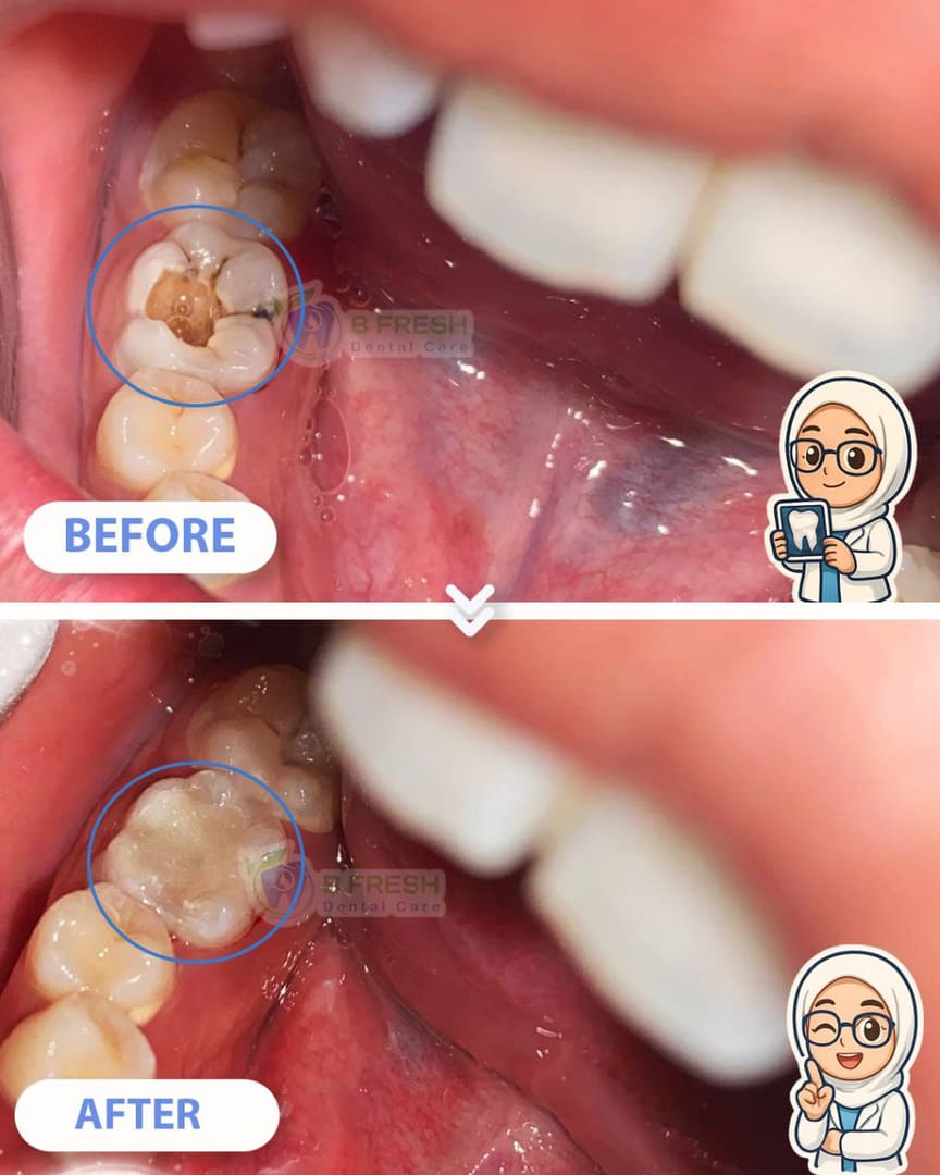 Tambal Gigi Belakang #23 — hasil perawatan kasus 1 di B Fresh Dental Care