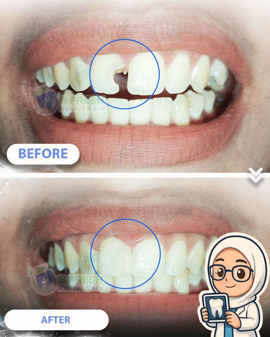 Tambal Gigi Depan #24 — hasil perawatan kasus 1 di B Fresh Dental Care