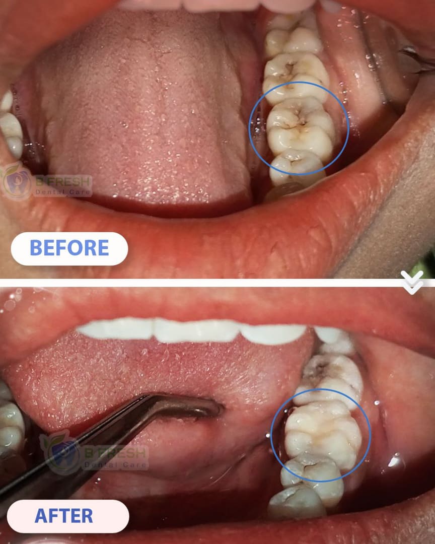 Tambal Gigi Belakang #25 — hasil perawatan kasus 1 di B Fresh Dental Care