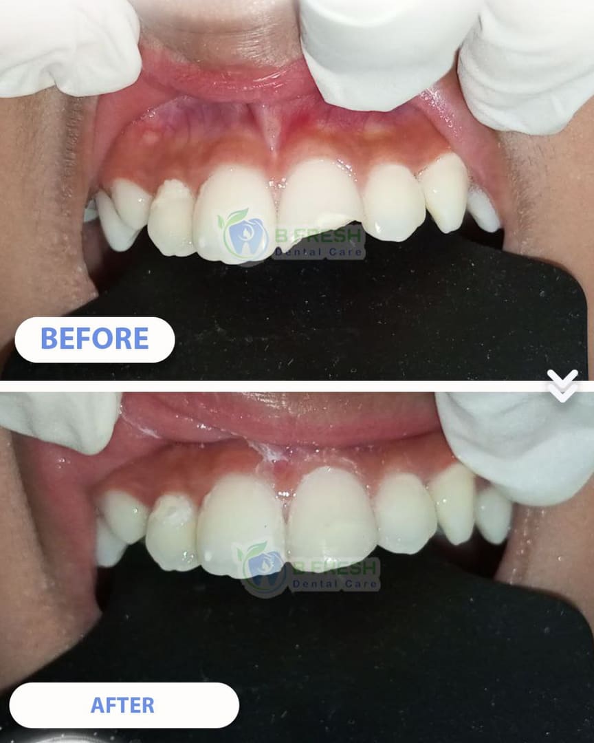 Tambal Gigi Depan #27 — hasil perawatan kasus 1 di B Fresh Dental Care